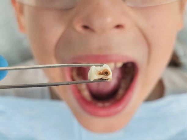 Best Emergency Dental Care for Broken or Chipped Teeth in Lindsay, TX